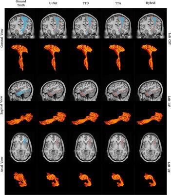 Informative and Reliable Tract Segmentation for Preoperative Planning